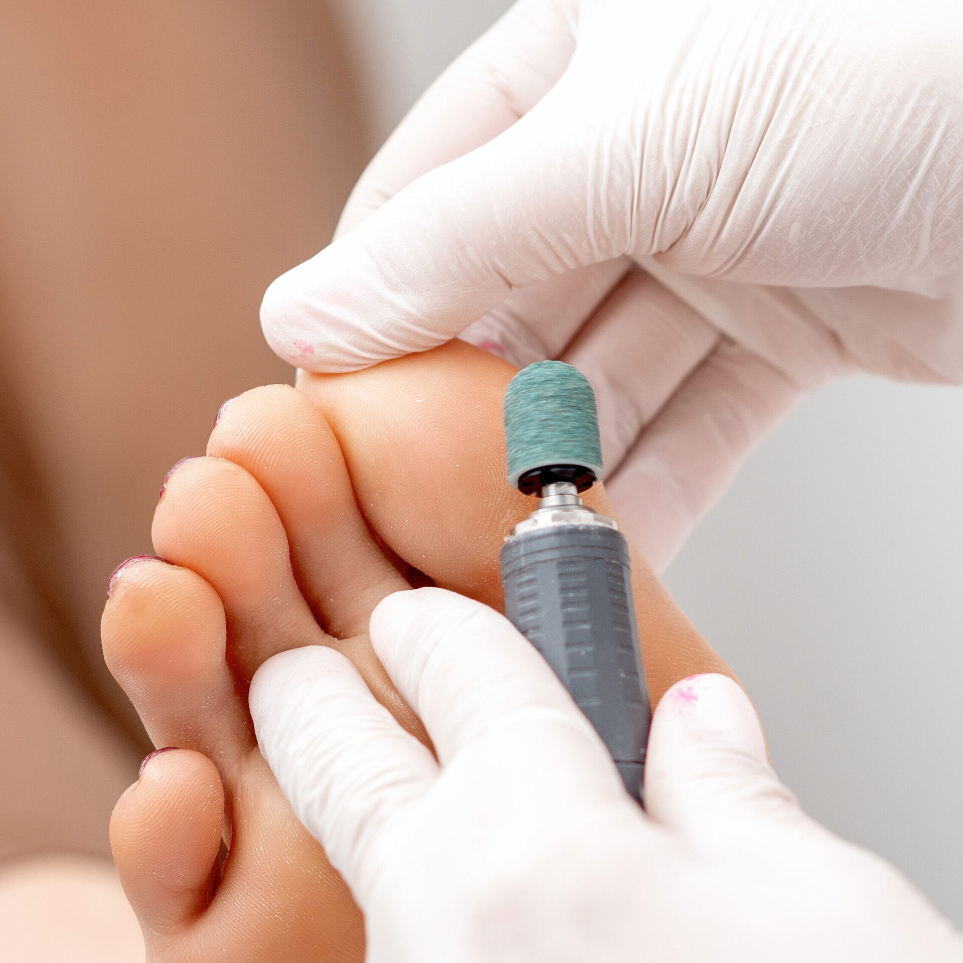 Fußspezialist beim Hornhaut entfernen an den Füßen steht für professionelle Fußpflege.